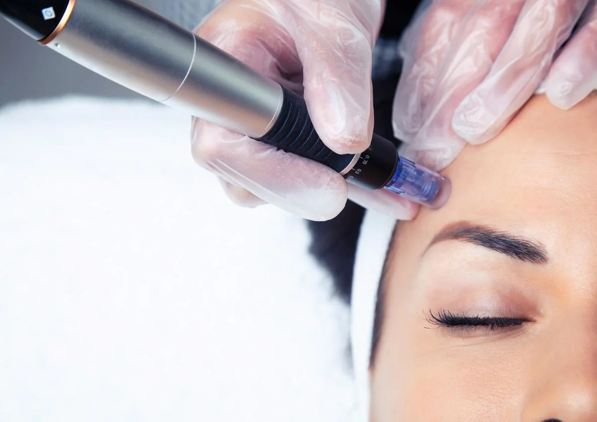 Microneedling & Mesotherapy Lift — Beauty Art Pro, Geneva (4)